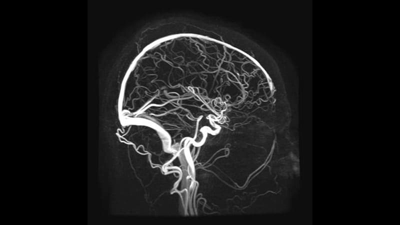 Преимущества МРТ артерий головы